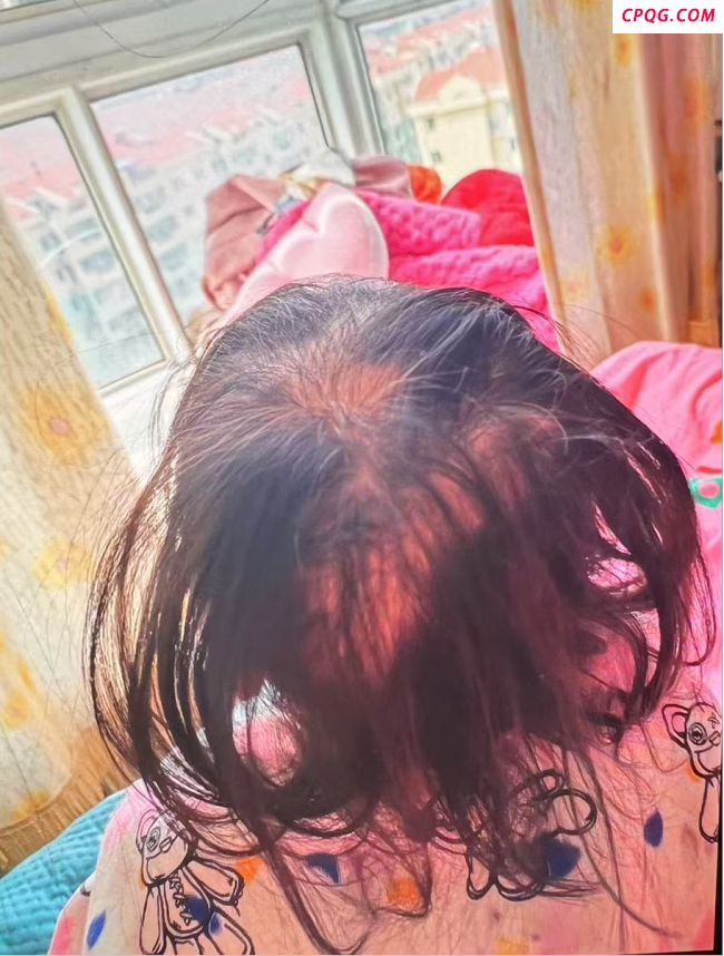 3岁女童突然脱发 查出铊中毒