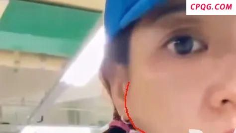陈意涵医美后脸歪了 脸部肿胀引发网友关注