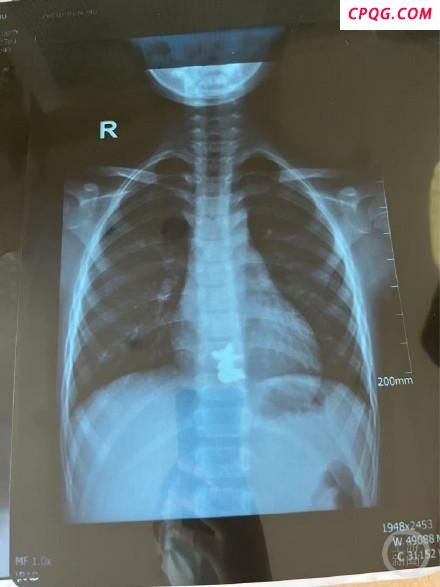 男孩吞服2枚磁铁致4处肠穿孔 紧急手术挽救生命