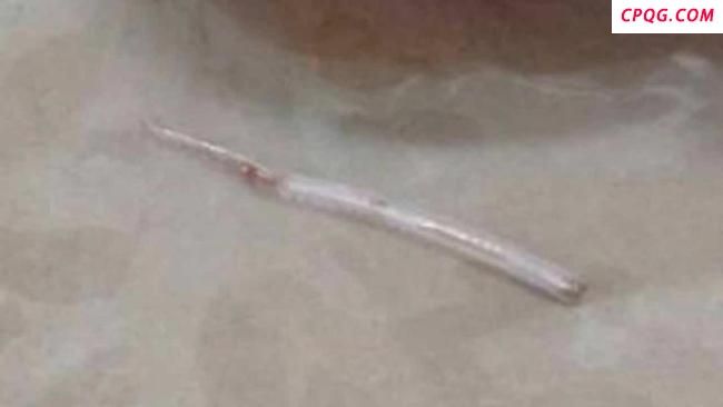 泰国女子吃鱼被鱼刺扎穿脖子 按摩痛处引发意外