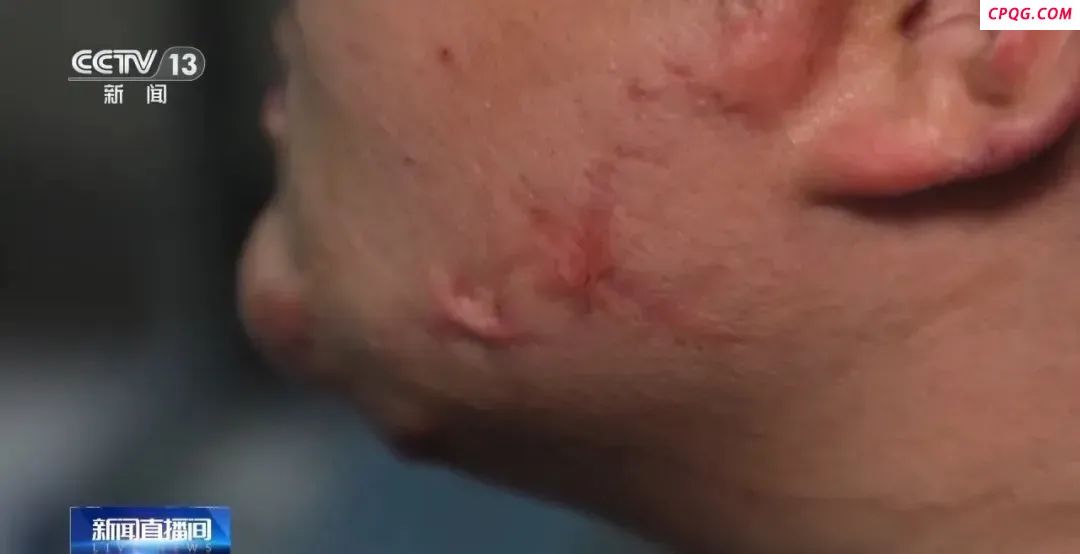 紧急提醒！有学生吸食火机气体成瘾，可在呼吸道爆燃……