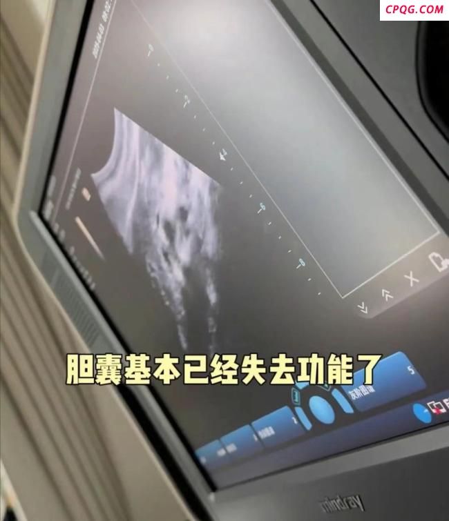 颖儿分享割胆手术经历 医生提醒 关注胆囊健康