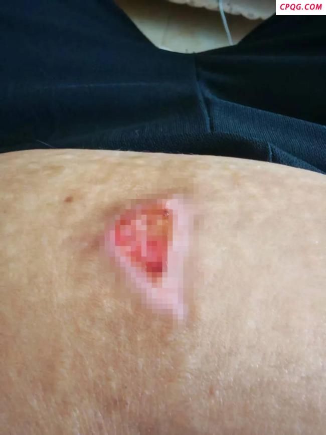 女子做艾灸腹部被烫伤 美容店赔偿