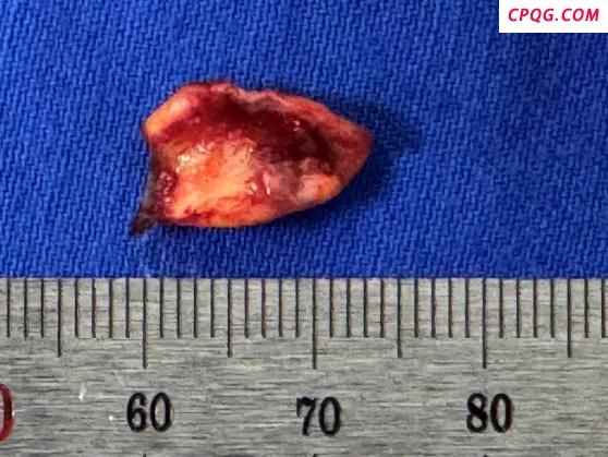 男子按摩后突发脑梗险丧命 不当按摩暗藏危机