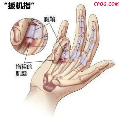 男子长期刷手机右手变成“扳机指” 警惕手指“罢工”信号