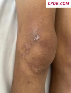 男子野外玩水突发高热确诊鼠尿病