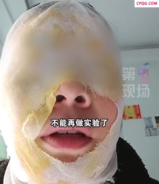 女子称用醋白糖去水垢爆炸脸被烫伤
